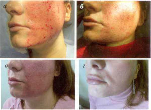 stages of skin restoration after fractional fractionation procedure