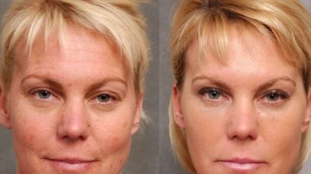 Before and after the renewal procedure