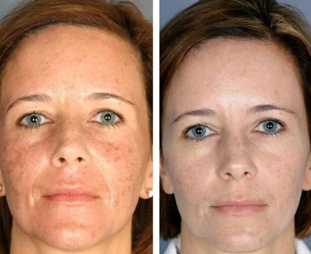Laser renovation