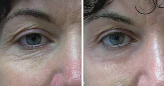 Skin laser around the eyes