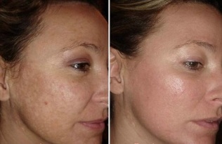laser skin rejuvenation before and after photos